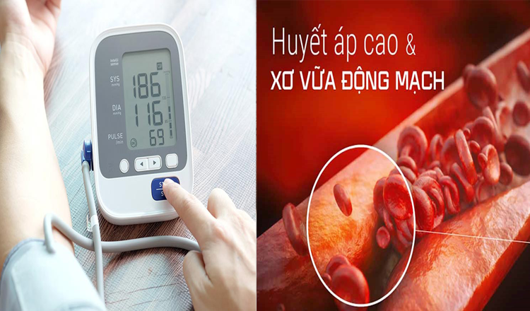 Huyết áp cao: Những điều bạn cần biết để phòng tránh xơ vữa động mạch Huyết áp cao: Những điều bạn cần biết để phòng tránh xơ vữa động mạch