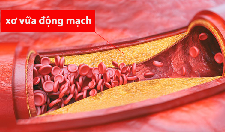 Chớ coi thường xơ vữa động mạch ở người có bệnh lý nền huyết áp cao, mỡ máu cao, tim mạch Chớ coi thường xơ vữa động mạch ở người có bệnh lý nền huyết áp cao, mỡ máu cao, tim mạch