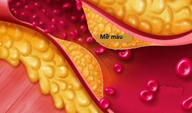 Kiểm soát mỡ máu cao ngăn chặn nguy cơ xơ vữa động mạch ảnh hưởng đến não và tim Kiểm soát mỡ máu cao ngăn chặn nguy cơ xơ vữa động mạch ảnh hưởng đến não và tim