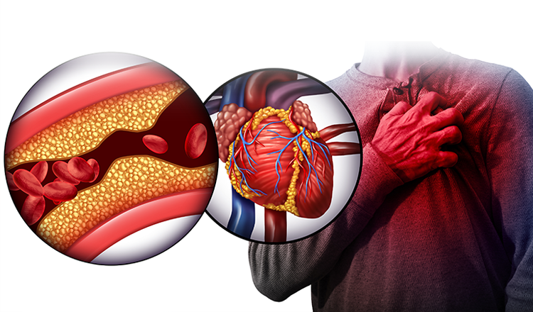 Đau nhói vùng tim, hồi hộp, khó thở ở người bệnh tim mạch cảnh báo nguy cơ xơ vữa động mạch vành Đau nhói vùng tim, hồi hộp, khó thở ở người bệnh tim mạch cảnh báo nguy cơ xơ vữa động mạch vành